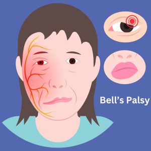 Bells palsy